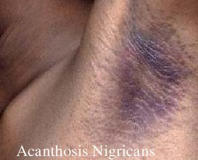 Ảnh 2 của Acanthosis Nigricans